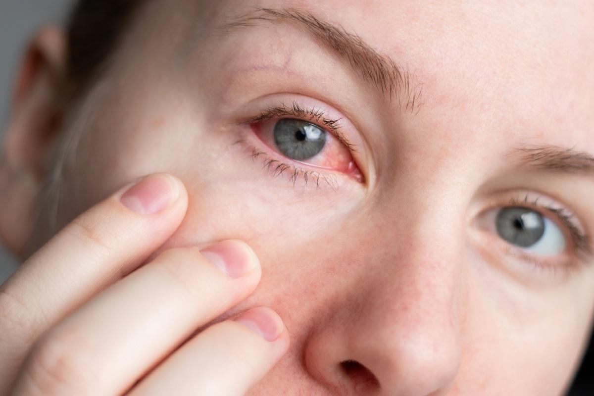 A person with a red irritated eye caused by dry eye
